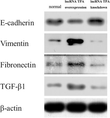 Study of lncRNA TPA in Promoting Invasion and Metastasis of Breast Cancer Mediated by TGF-β Signaling Pathway